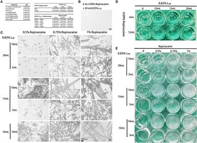 Neurologic Complication Due to Crystallization After Drug Interaction Between Alkalized Lidocaine and Ropivacaine: A Case Report and in vitro Study